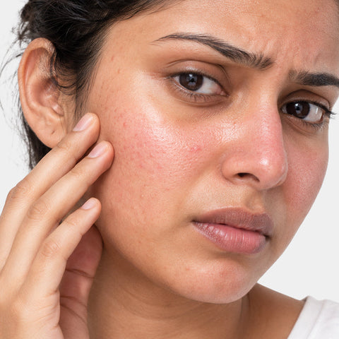 Sensitive and irritated skin