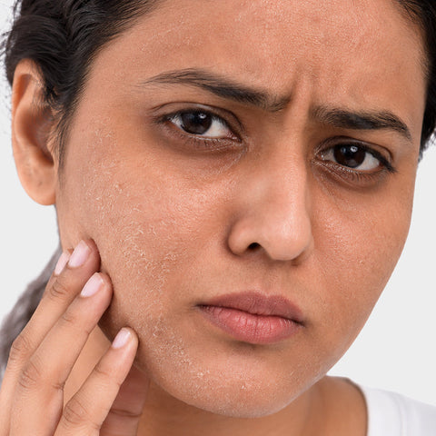 Dry and dehydrated skin