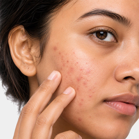 Acne and breakouts