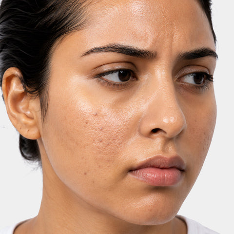 Oil control and clogged pores