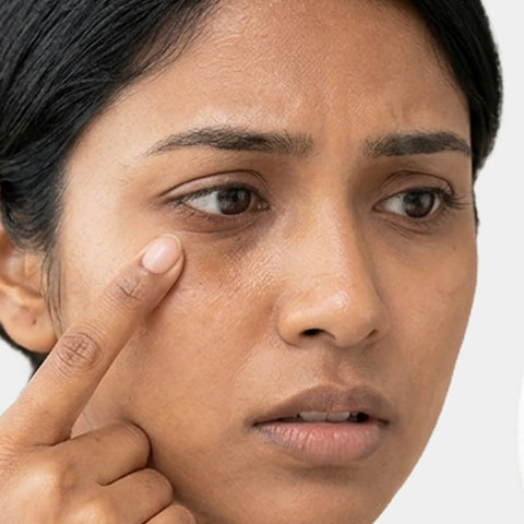 Dark circles and puffiness