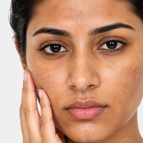 Uneven skin tone