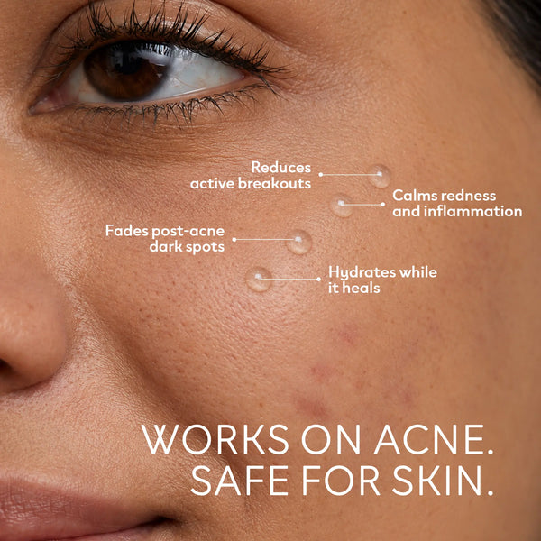 Anti Acne PM Gel